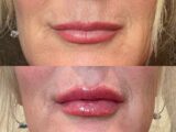 Botox for lips