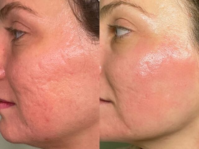 RF Microneedling pre-post