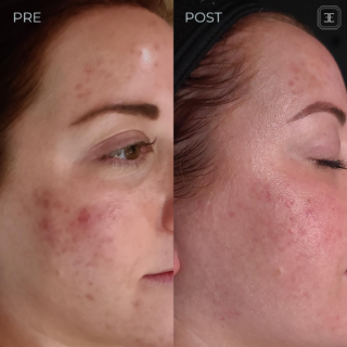 Before and After RF Microneedling 