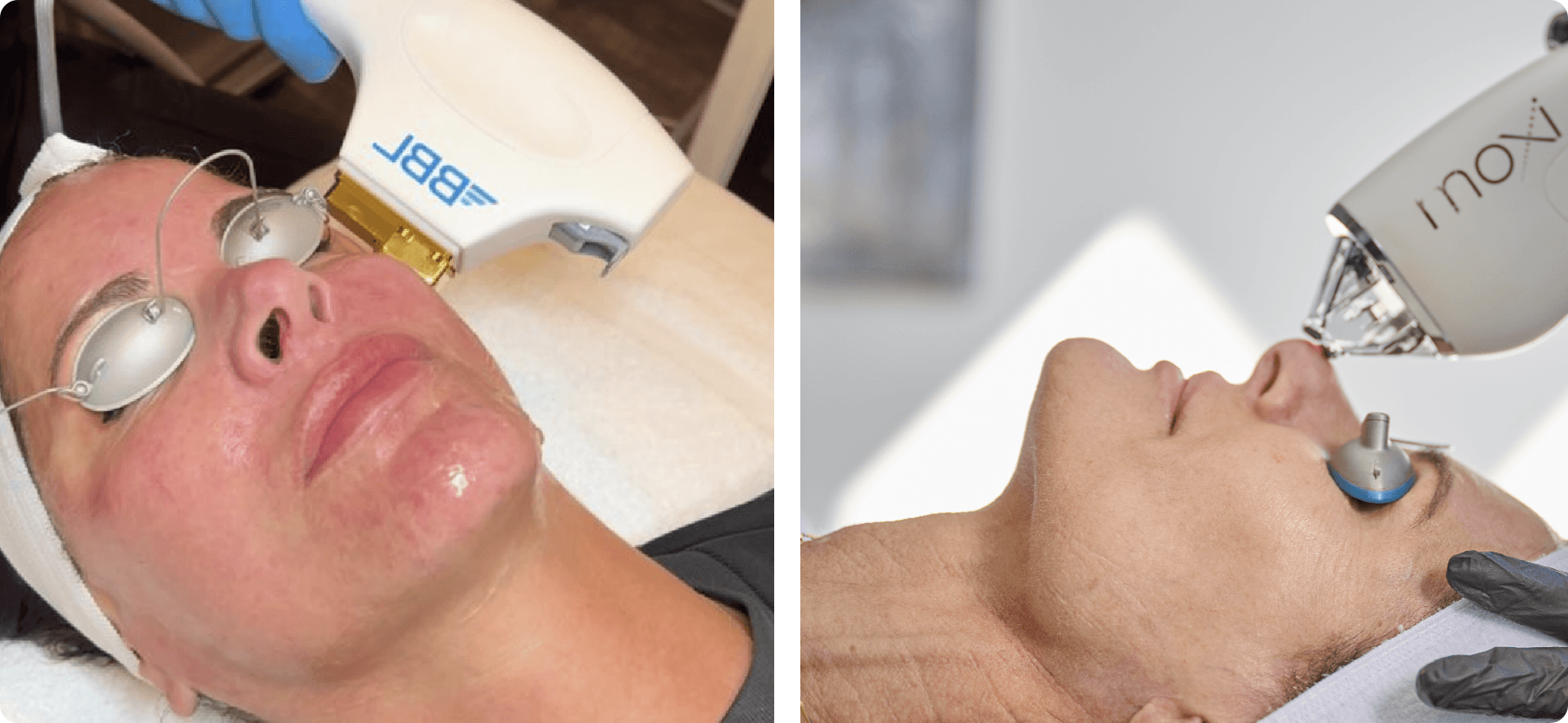 BBL Laser vs. Moxi: Which is Better? | Elase