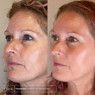 Moxi and BBL before and after
