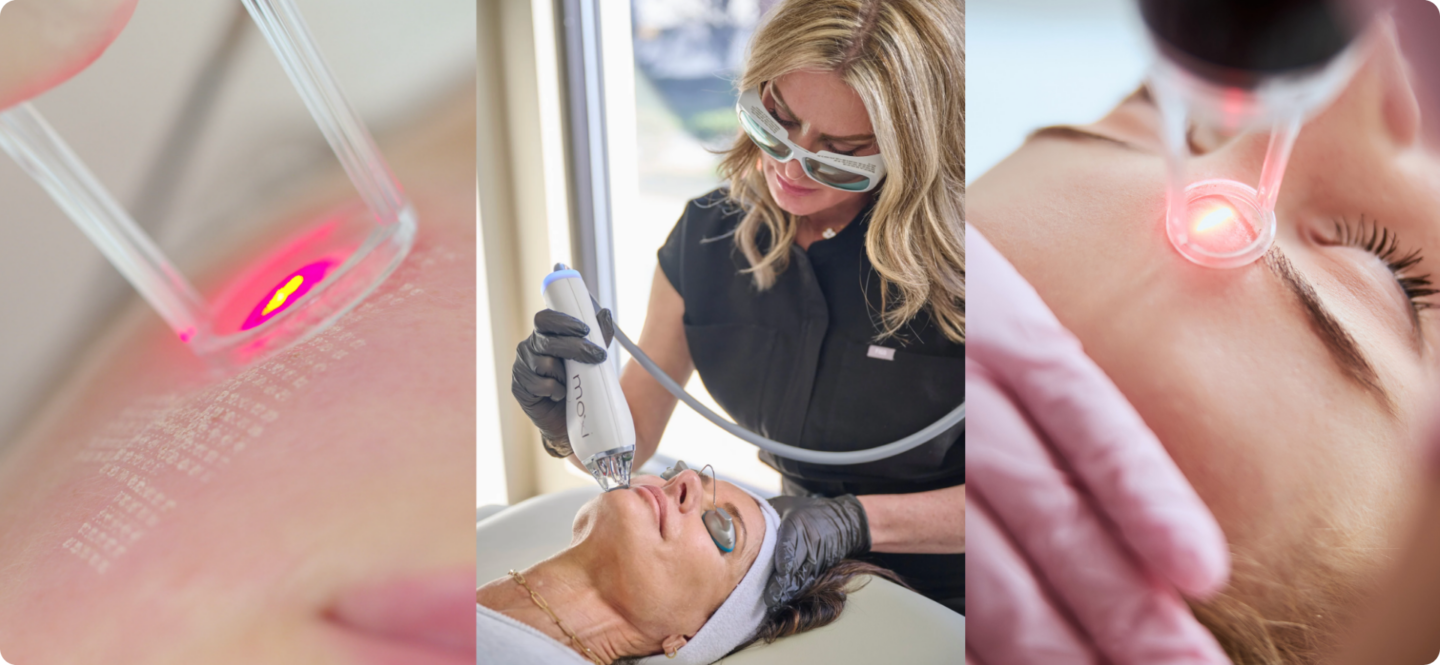 Unlocking the Benefits of Moxi Laser Treatment for Radiant Skin