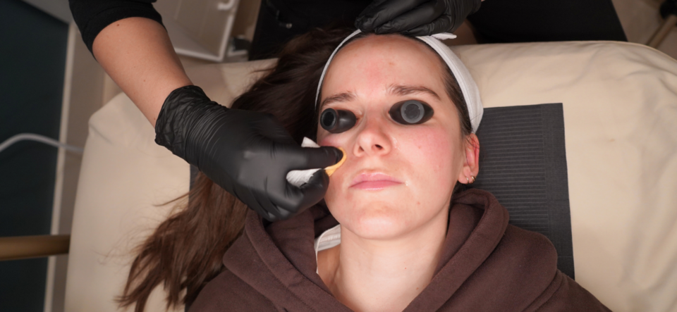 Chemical Peel Aftercare