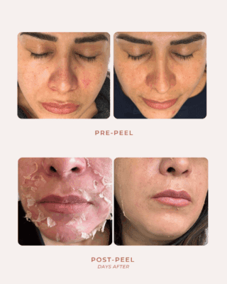 Close-up comparison showing pre-peel and post-peel results on facial skin. The pre-peel images show redness and uneven tone, while the post-peel images show mild flaking followed by smoother, clearer skin after a chemical peel at Elase Med Spa.