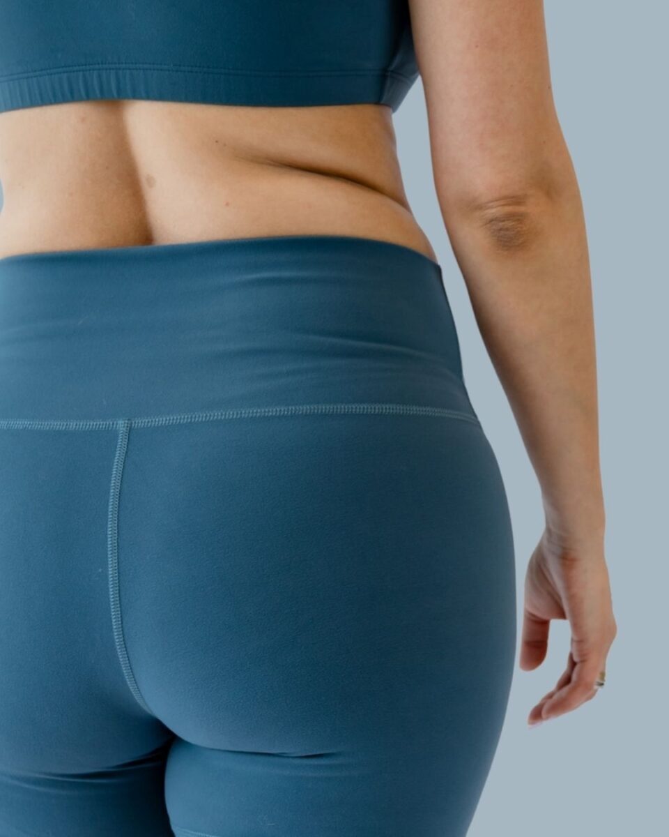 Sculptra Butt Lift
