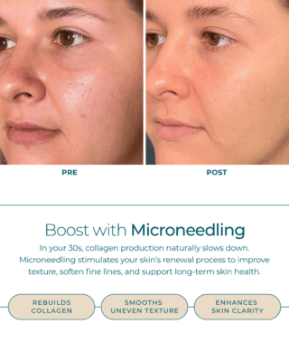 Thirties-Microneedling