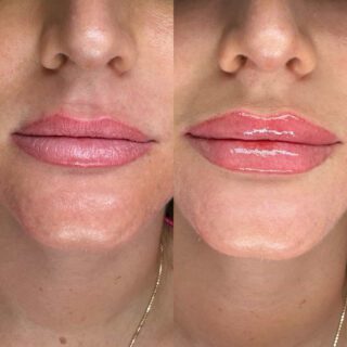 Side-by-side of Suzie's lips after dissolving (left) and natural-looking lip filler with Rachel at Elase (right).