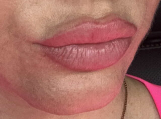 Close-up of Suzie's overfilled lips from a previous provider, before lip filler dissolving treatment at Elase.