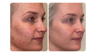 Elase clients before and after four sessions of Moxi laser