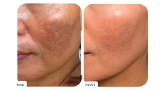 Cheek pigmentation before and after a series of BBL + Moxi laser treatments at Elase. 